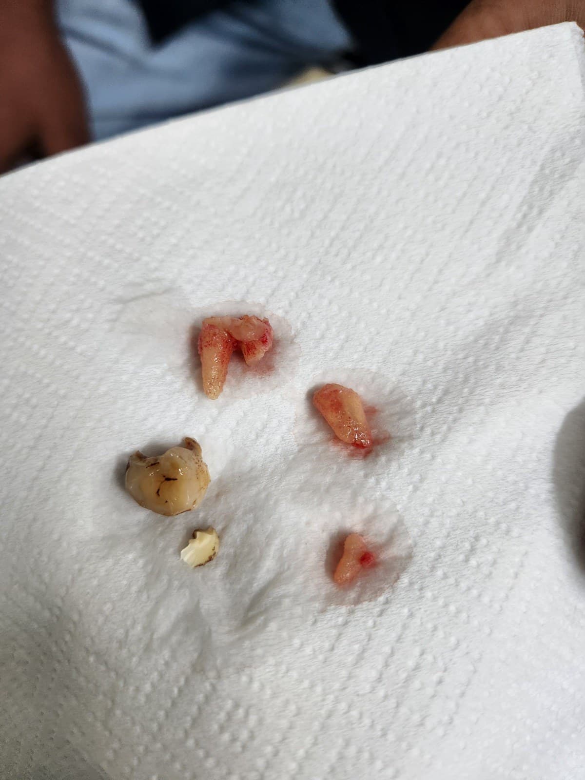 Wisdom tooth removal