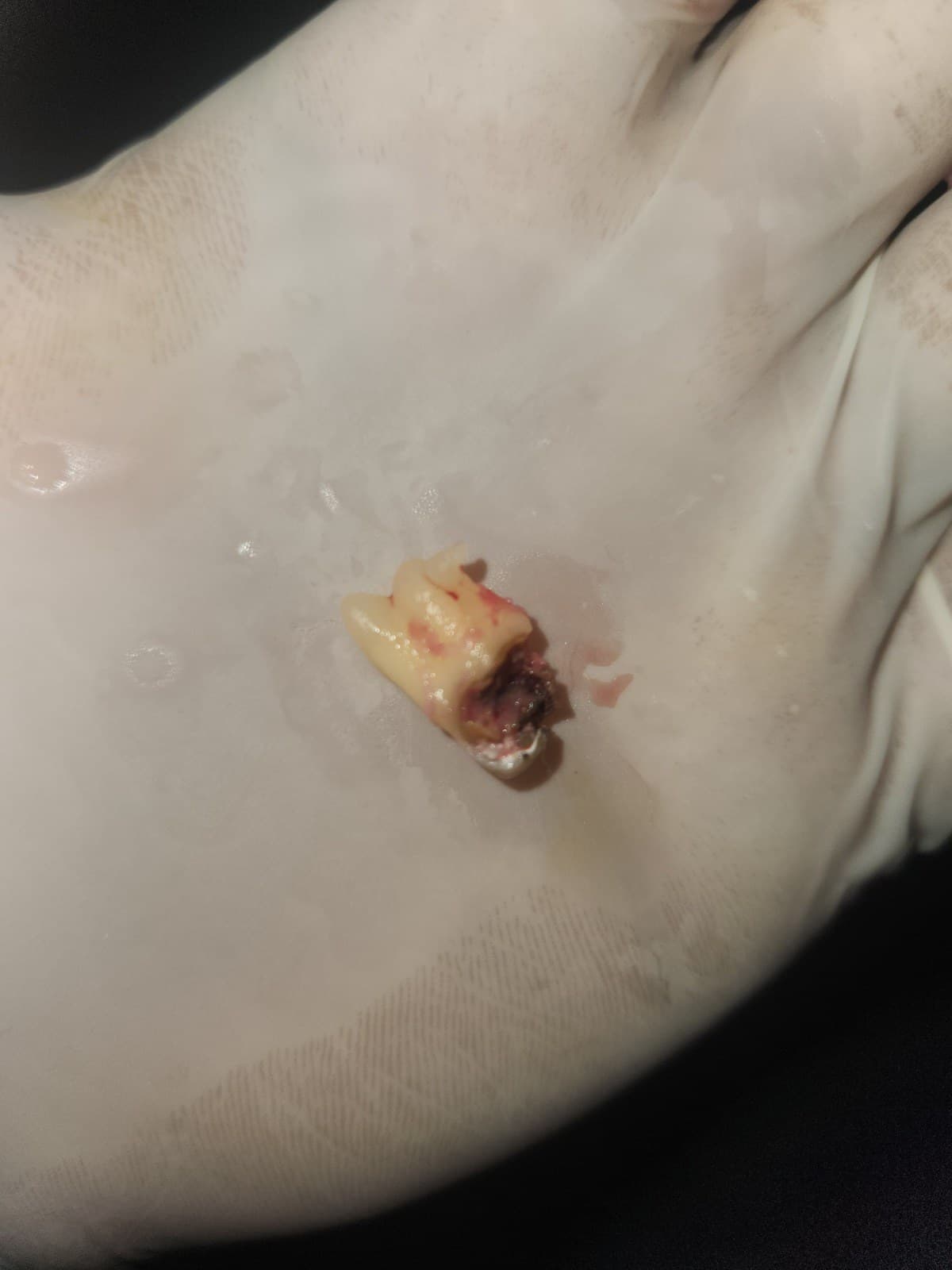 Wisdom tooth removal