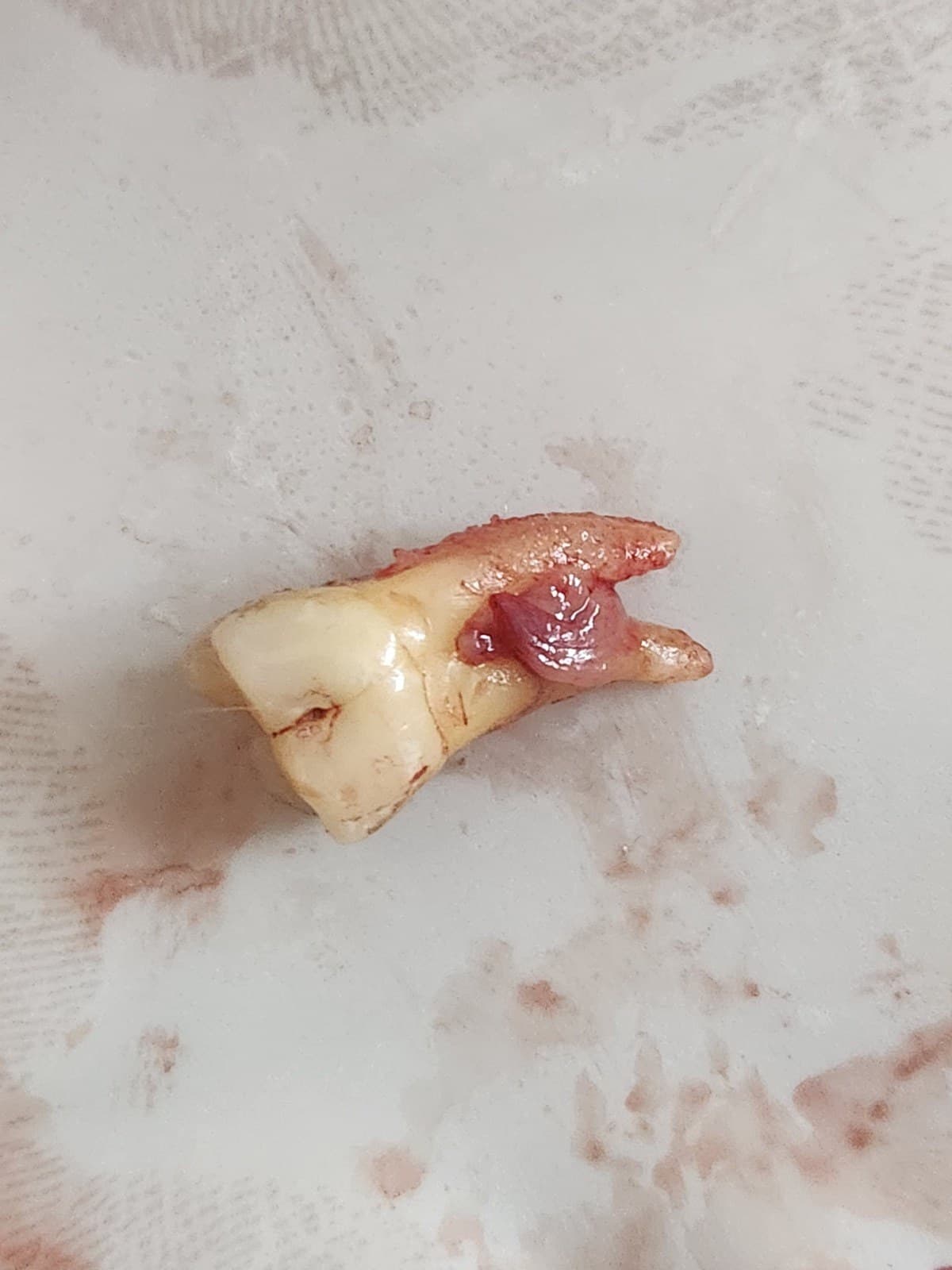 Wisdom tooth removal