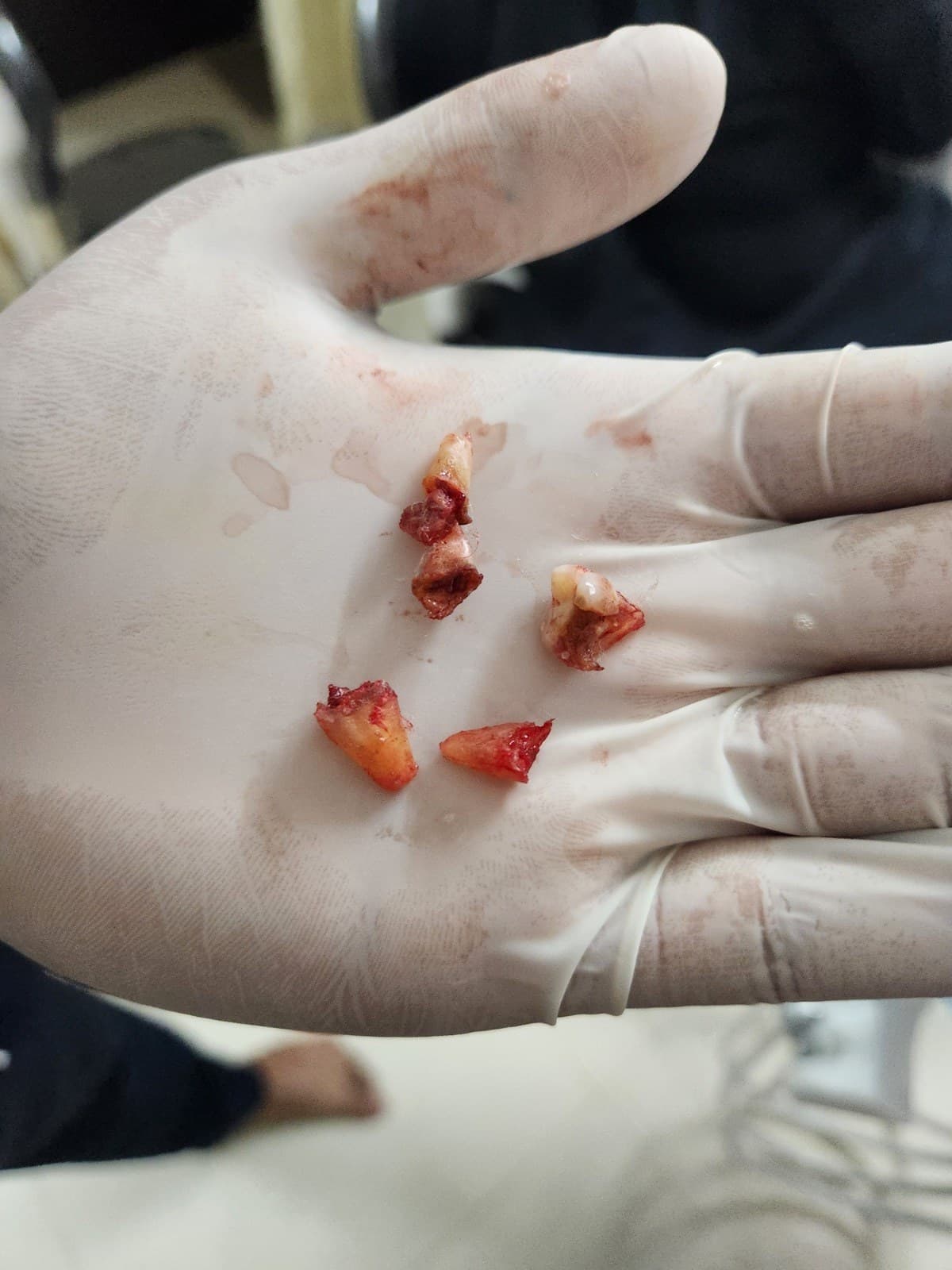 Wisdom tooth removal
