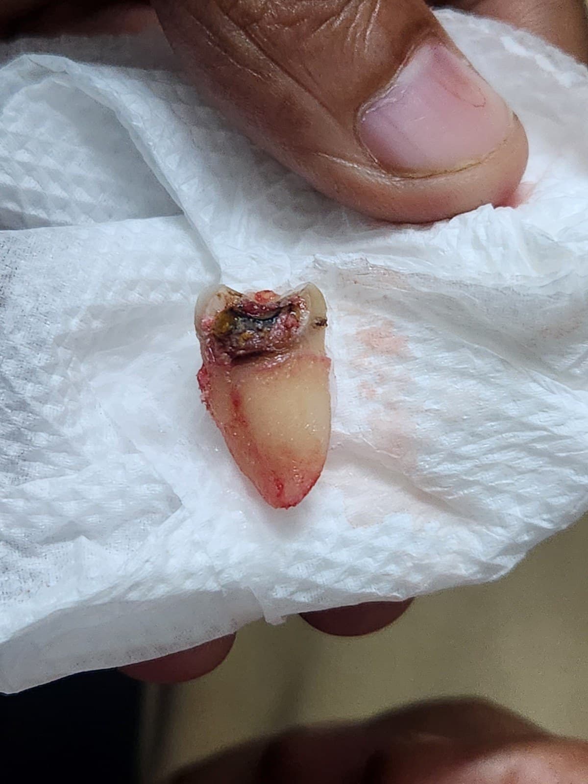 Wisdom tooth removal