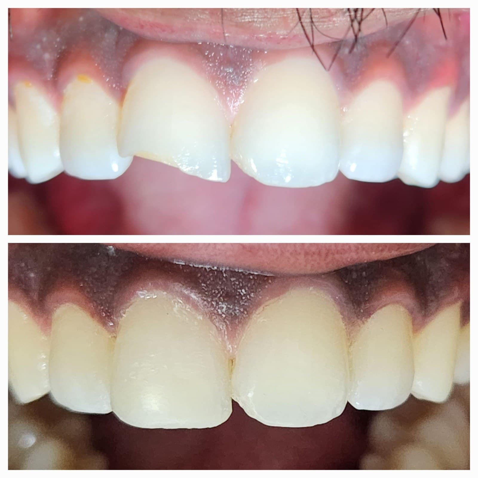 Alignment journey - Orthodontics