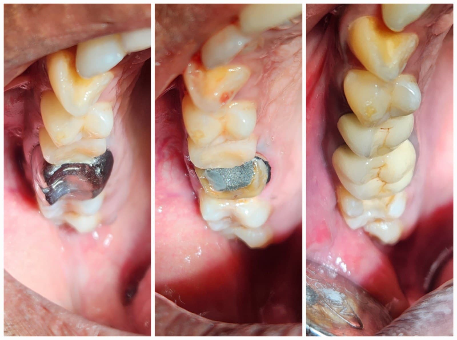 Single implant - Implant · Crown